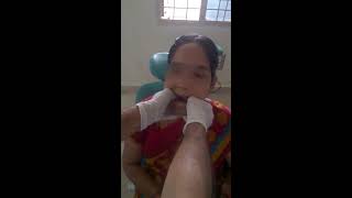 Jaw Joint Dislocation Slip  Manual Reduction Self  at Home Treatment DIY [upl. by Stephie54]