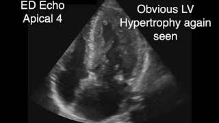 Hypertrophic Obstructive Cardiomyopathy with SAM [upl. by Eisenstark]