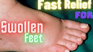 Swollen Feet  Causes and Remedies [upl. by Sitoel69]