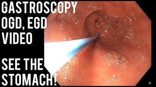 Gastroscopy  OGD  See inside the stomach [upl. by Chaffee174]