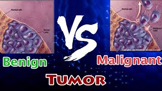 Malignant melanoma Signs Pathophysiology Types Diagnosis Treatment [upl. by Atiuqrahs]