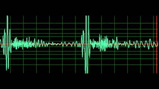 Mitral Regurgitation slow [upl. by Sigrid]