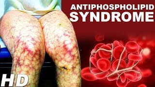 Antiphospholipid Antibody Syndrome An Autoimmune Disease  Antiphospholipid Treatments And Symptoms [upl. by Noevad825]