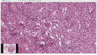 Adenomatoid Tumor  Histopathology [upl. by Inilam]