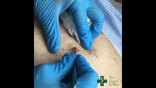 Removal of Seborrheic Keratosis [upl. by Annoerb]