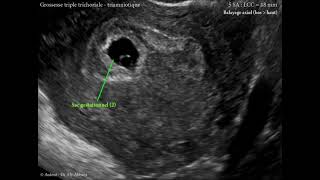 Grossesse multiple triple trichoriale et triamniotique de 5 SA LCC  18 mm [upl. by Feilak217]