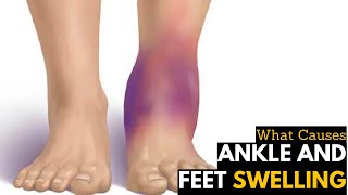 What Causes Ankles amp Feet Swelling  Diagnosis amp Treatment [upl. by Duwe]