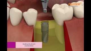 OSSTEM IMPLANT TSIII System Surgical Procedure Taper Kit and Straight Drill Kit [upl. by Aleek504]