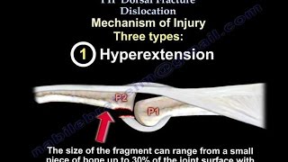 PIP Dorsal Fracture Dislocation  Everything You Need To Know  Dr Nabil Ebraheim [upl. by Onaicnop]