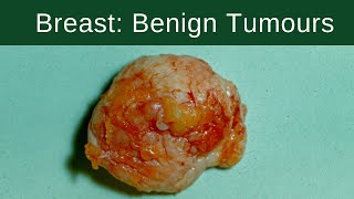 Differences between benign and malignant tumor [upl. by Froehlich]