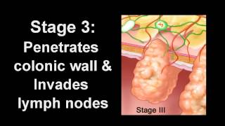 Colon Cancer Diagnosis amp Treatment  Los Angeles Colonoscopy [upl. by Bronk665]