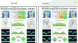 10 Hacks for OCT Interpretation in Glaucoma  Dr Mark Dunbar [upl. by Hewet]