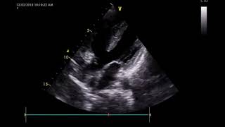 Tetralogy of Fallot TOF [upl. by Meenen]