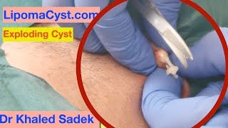 Dr Khaled Sadek Neck Cyst Removal LipomaCystcom [upl. by Risteau]