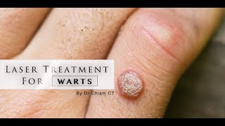 Warts removal with Laser Treatment  Dr Chiam CT [upl. by Esaj903]