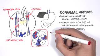 Upper GI Bleed Causes Overview [upl. by Naeerb]