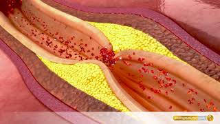 Gefäßverschluss So entsteht Arteriosklerose [upl. by Ruhtua]