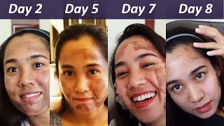 Miras chemical peel recovery daybyday [upl. by Reni]