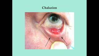 Disorders of the Eye Lid  CRASH Medical Review Series [upl. by Mildred]