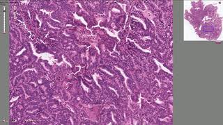 Endometrial Adenocarcinoma  Histopathology [upl. by Ecydnarb657]