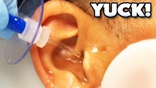 GIANT EAR WAX REMOVAL  Dr ER [upl. by Yrogreg]