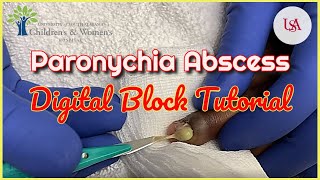 Finger Paronychia Emergency amp Digital Block Tutorial [upl. by Tihom]