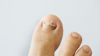 How to prevent and treat nail fungus [upl. by Cattier]