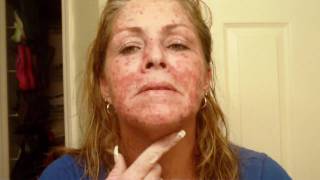 Skin Cancer My VlogJournal Treatment W EFUDEX vid10 [upl. by Clarey]