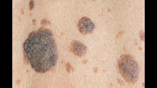 seborrheic keratosis removal beautyteck [upl. by Boleslaw]