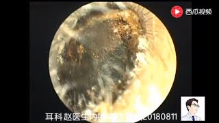 Ear endoscope cleaning the external auditory canal and answering common questions [upl. by Aicilaf378]