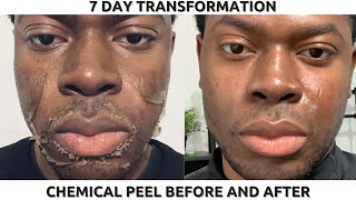 CHEMICAL PEEL ON BLACK SKIN  FULL PROCESS BEFORE amp AFTER  HYPERPIGMENTATION amp DARK SPOTS [upl. by Bor]