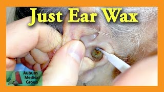 Ear Wax Removal Doctor  Auburn Medical Group [upl. by Wilkens]