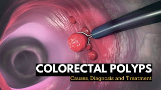 Colorectal Polyps Causes Signs and Symptoms Diagnosis and Treatment [upl. by Ysle]