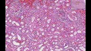 Histopathology KidneyInterstitial nephritis [upl. by Nevah]