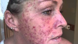 Skin Cancer My VlogJournal Treatment W EFUDEX vid9 [upl. by Toombs]