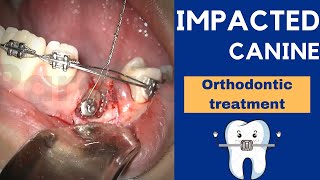 IMPACTED CANINE exposure treatment with ORTHODONTICS and braces  Step by step [upl. by Enilram165]