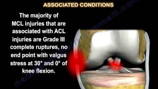 Anterior Cruciate Ligament Pathology and Management  Animated Tutorial [upl. by Yroger693]