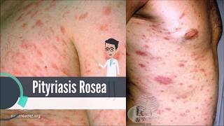 What is Pityriasis Rosea [upl. by Chiang926]