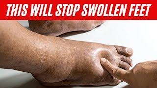 Home Remedies for Swollen Feet  Edema Remedy [upl. by Melody253]