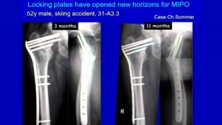 Femoral Fracture Fixation Surgery Intramedullary Nail [upl. by Norris]