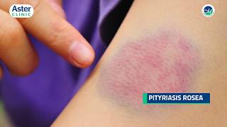 Dr Srinivasa Munivenkatappa talks about Pityriasis Rosea [upl. by Marcile]