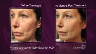 Thermage Skin Tightening [upl. by Romelda]