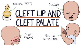 Cleft Lip and Cleft Palate For Students [upl. by Nyrhtakyram]