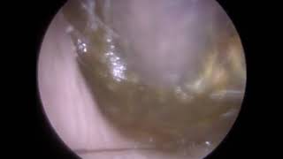 275  Ear Wax Removal Video demonstrating Endoscopic Ear Microsuction E suction® [upl. by Thordia]