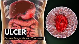 Ulcer Causes Signs and Symptoms Diagnosis and Treatment [upl. by Eniretac718]