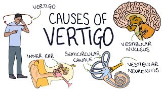 Maneuvers to Diagnosis and Treat Benign Paroxysmal Positional Vertigo  NEJM [upl. by Pinelli]