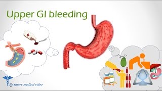 Quick review Upper GI Bleeding GI Bleed Upper GI Bleed Causes [upl. by Reffinej]