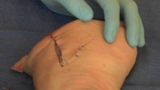 Suture  Dog Ear [upl. by Seravat]