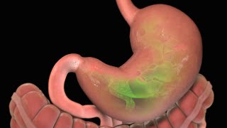 Stomach Ulcer  Nucleus Health [upl. by Nataniel]