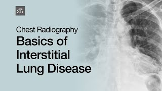 Chest Radiography Basics of Interstitial Lung Disease [upl. by Worden]